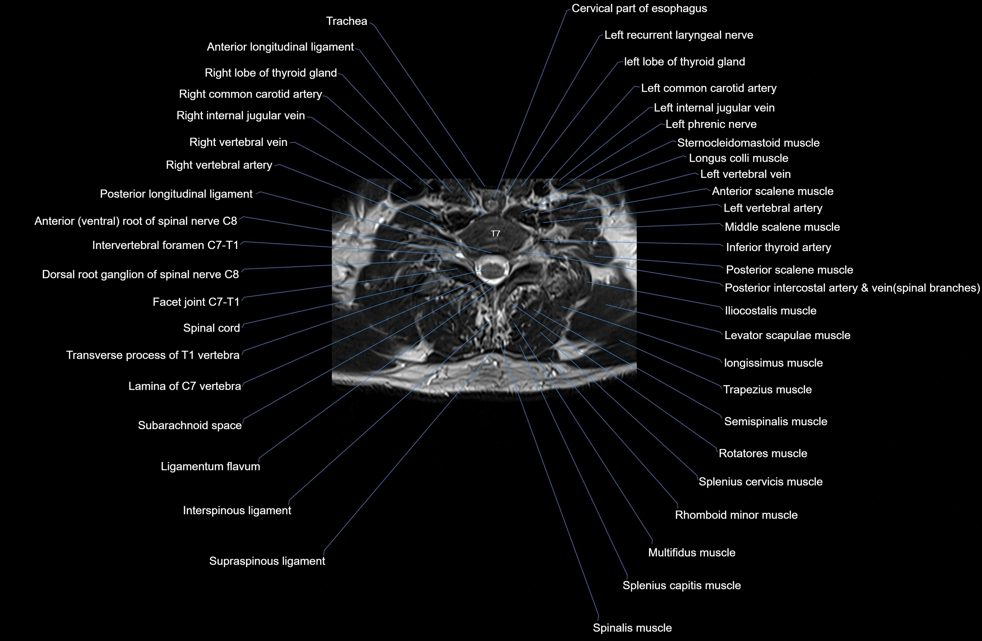 MRI thoracic spine axial  cross sectional anatomy 3T radiology  image-img-00001-00005.webp